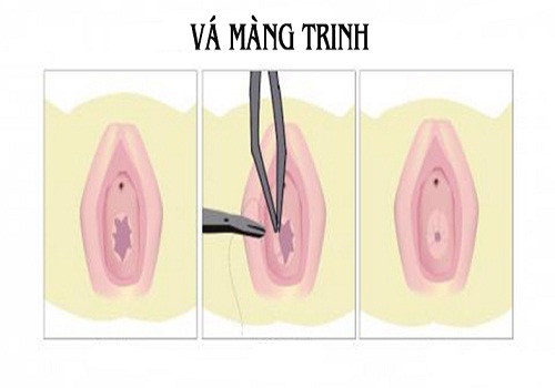 Phương pháp vá màng trinh